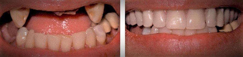 implants - dental implants before and after dental office in hillsboro oregon - Dental Implants - photo Dental Implants implants - dental implants before and after dental office in hillsboro oregon - Dental Implants