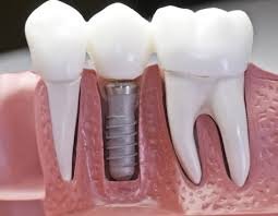 implants - dental implant inhillsboro oregon East Wind Dental Care - Dental Implants - photo implants - dental implant inhillsboro oregon East Wind Dental Care - Dental Implants