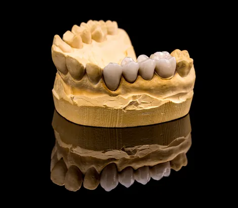 Dental crowns and bridges Hillsboro - restore damaged teeth
