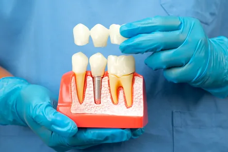 Dental implants Hillsboro Oregon - permanent tooth replacement at East Wind Dental Care
