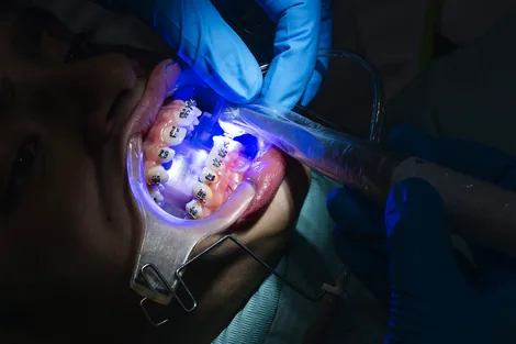 Tooth-colored fillings Hillsboro - mercury-free aesthetic cavity repair