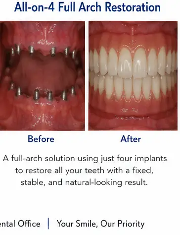 All-on-4 Full Arch Restoration educational before and after dental treatment image for East Wind Dental Care, a Hillsboro dental office offering full arch dental implants in Hillsboro, Oregon and nearby communities.
