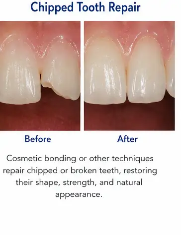 Chipped Tooth Repair educational before and after dental treatment image for East Wind Dental Care, a Hillsboro dental office offering emergency and cosmetic dentistry in Hillsboro, Oregon and nearby communities.