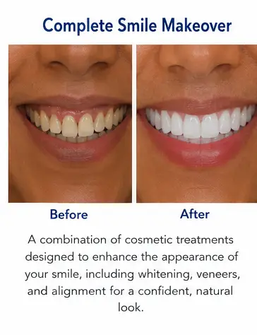 Complete Smile Makeover educational before and after dental treatment image for East Wind Dental Care, a Hillsboro dental office offering cosmetic dentistry in Hillsboro, Oregon and nearby communities.