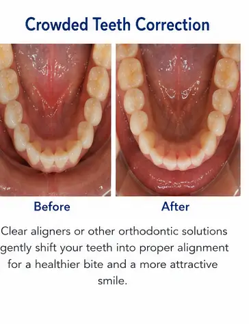 Crowded Teeth Correction educational before and after dental treatment image for East Wind Dental Care, a Hillsboro dental office offering clear aligners and orthodontic dentistry in Hillsboro, Oregon and nearby communities.