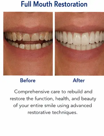 Full Mouth Restoration educational before and after dental treatment image for East Wind Dental Care, a Hillsboro dental office offering restorative dentistry in Hillsboro, Oregon and nearby communities.