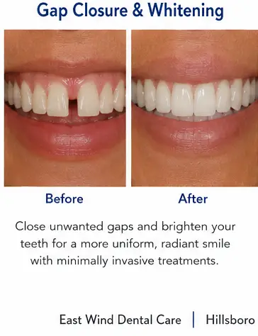Gap Closure and Whitening educational before and after dental treatment image for East Wind Dental Care, a Hillsboro dental office offering cosmetic dentistry in Hillsboro, Oregon and nearby communities.