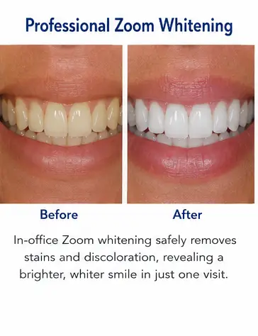 Professional Zoom Whitening educational before and after dental treatment image for East Wind Dental Care, a Hillsboro dental office offering teeth whitening in Hillsboro, Oregon and nearby communities.