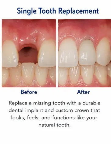 Single Tooth Replacement educational before and after dental treatment image for East Wind Dental Care, a Hillsboro dental office offering dental implants in Hillsboro, Oregon and nearby communities.
